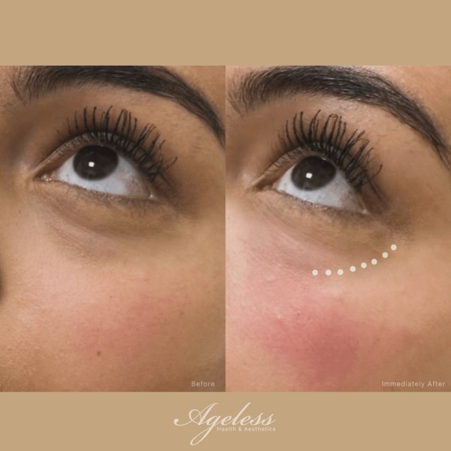 Under-eye area before and immediately after PRFM treatment - reduced hollowing after