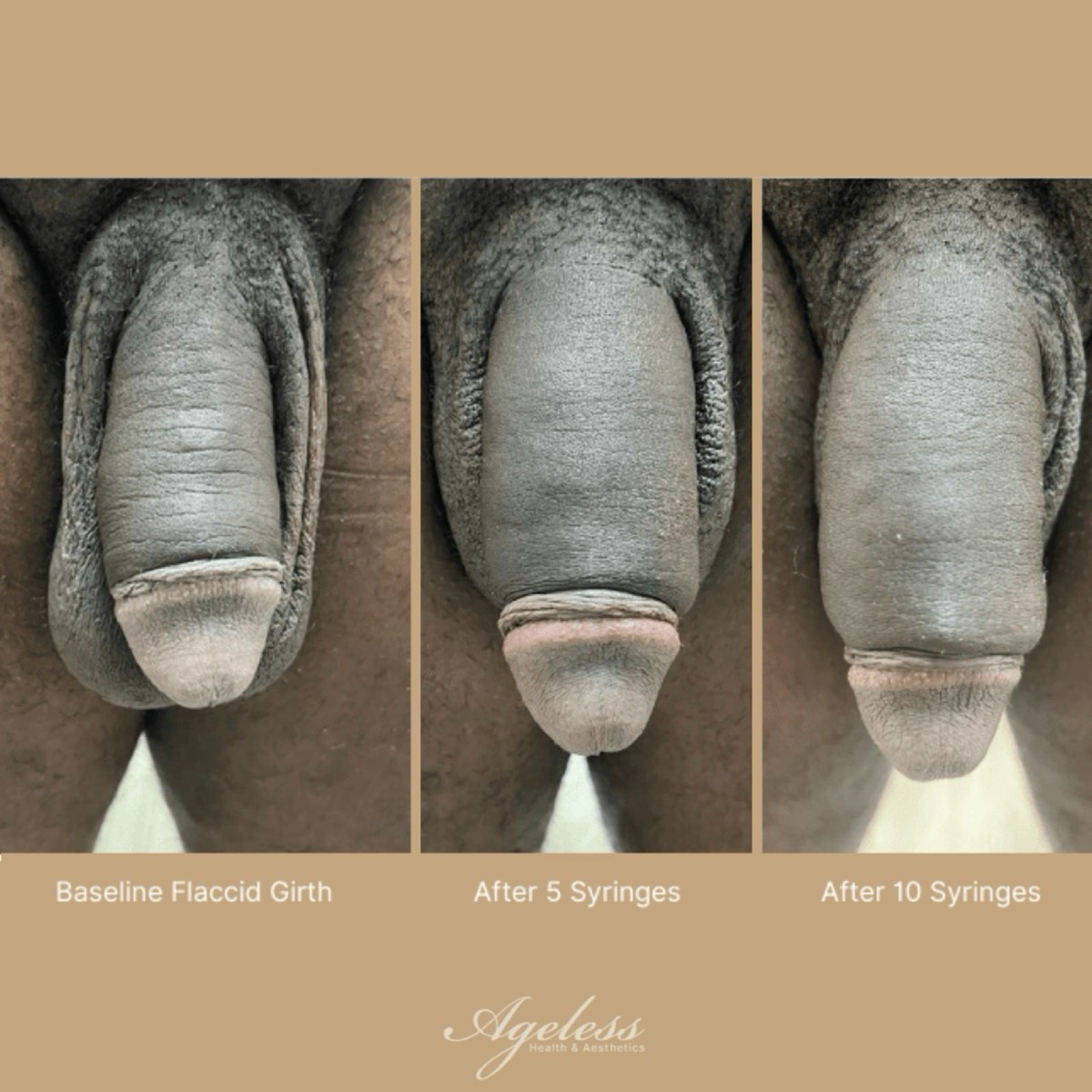 Clinical progression of penile girth enhancement: baseline, after five syringes, and after ten syringes