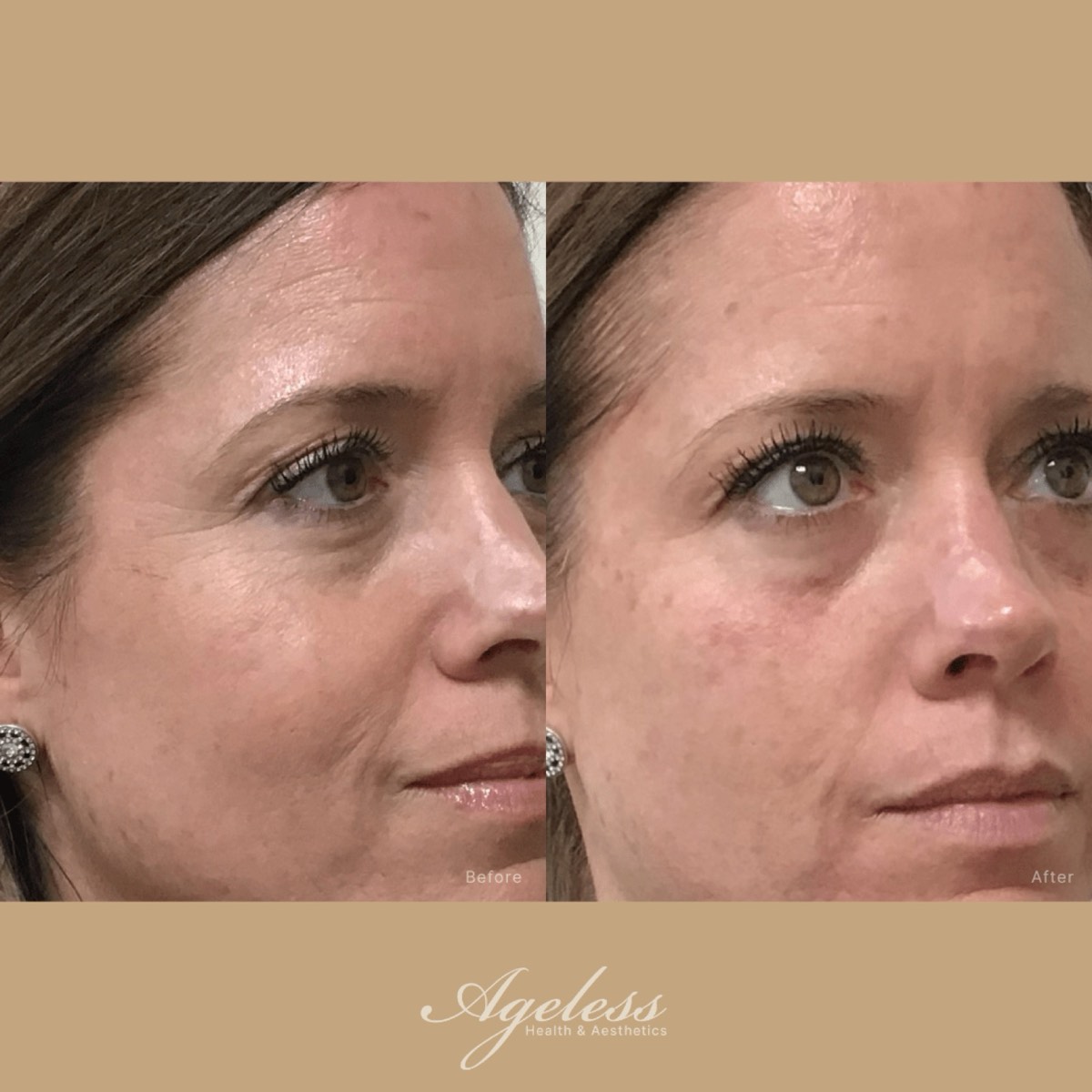 Before and after of a glass skin facial - smoother, more luminous skin after