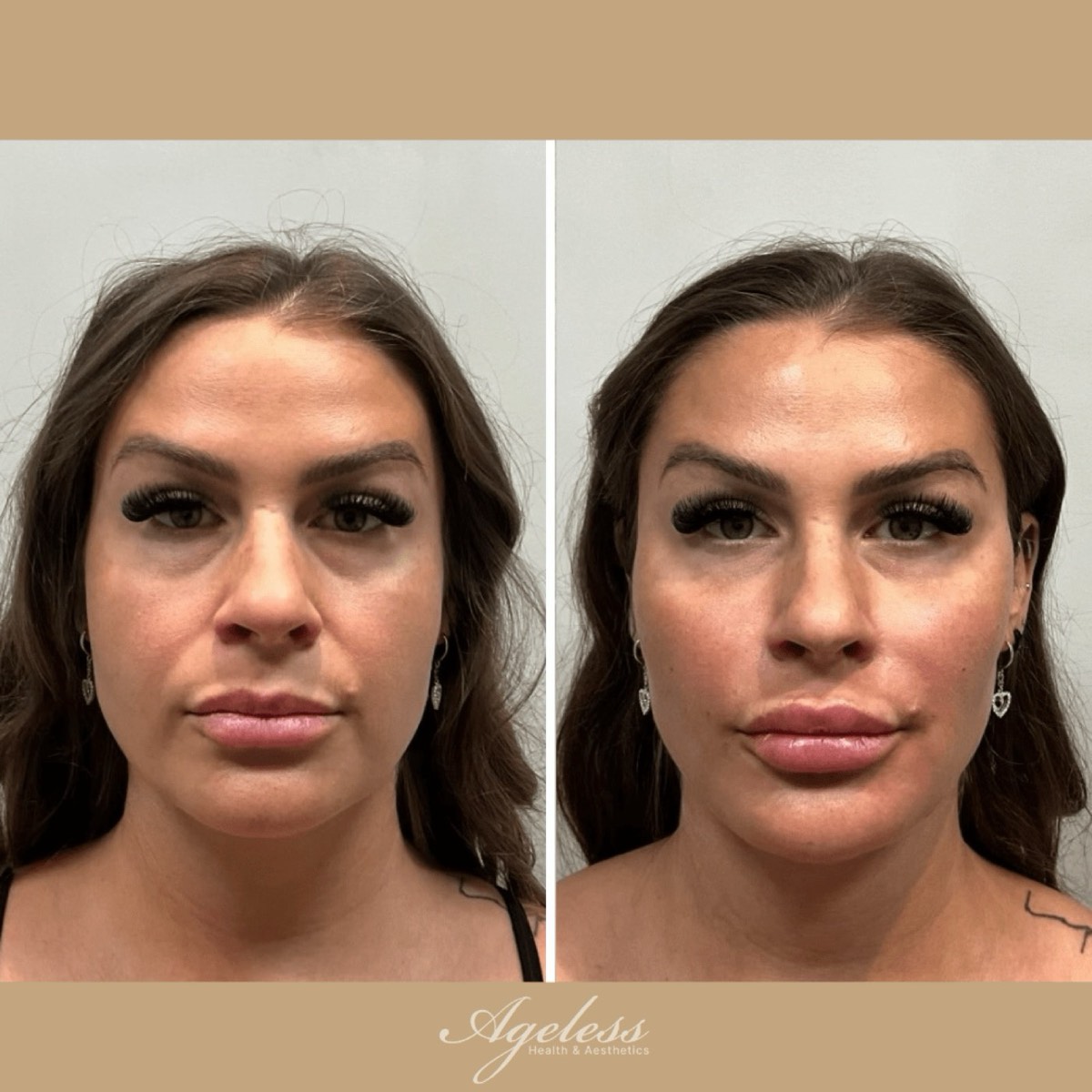 Before and after lip filler, front view — before on the left, fuller defined lips after on the right